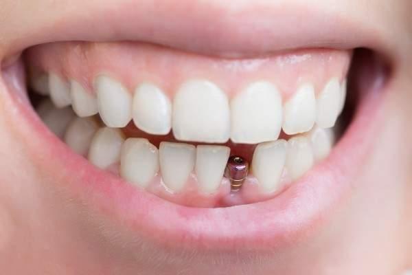 dental Implant Cheltenham