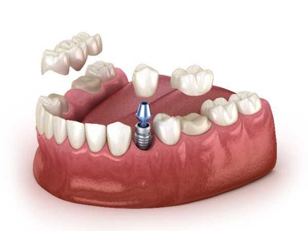 dental implant Doncaster