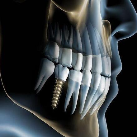 Dental Implantsedinburgh